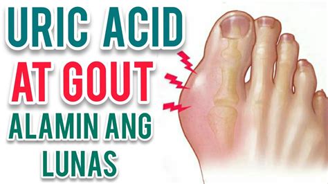 ano ang uric acid tagalog